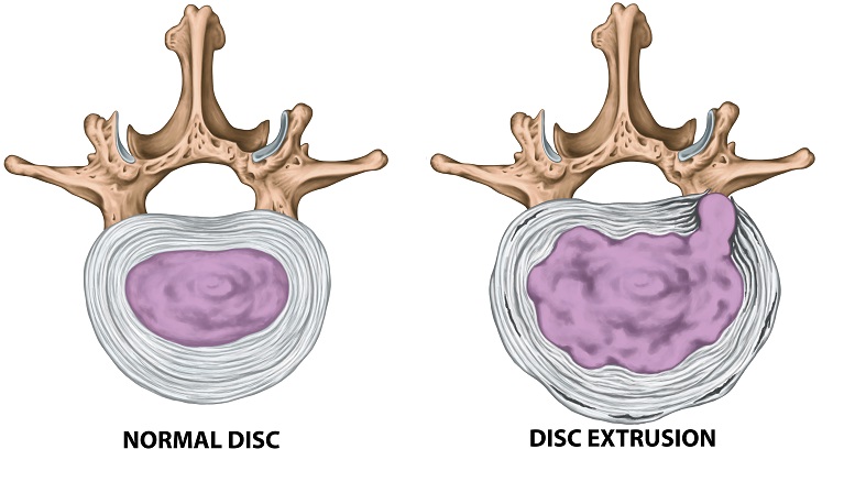 Extruded Discs | Alabama Pain Physicians