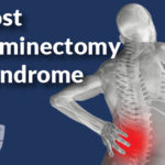 Post Laminectomy Syndrome