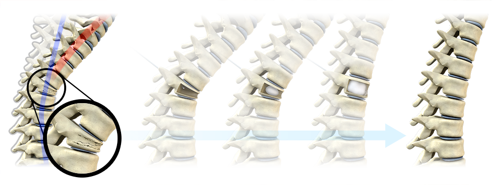 How Painful Is A Compression Fracture? - Hadi Medical Group